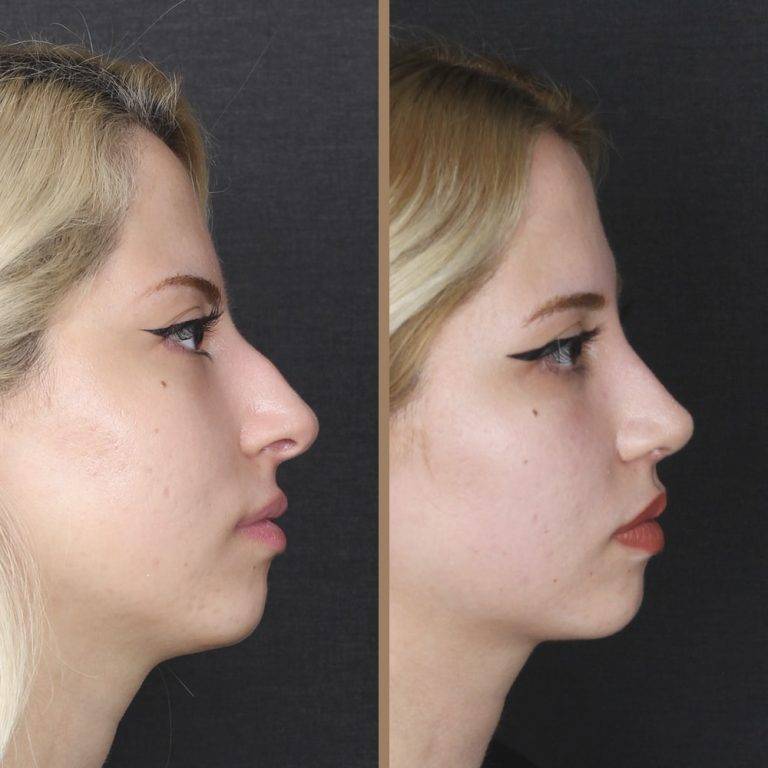 antalya-rhinoplasty-surgery-cost-dr-nazli-selvi-11