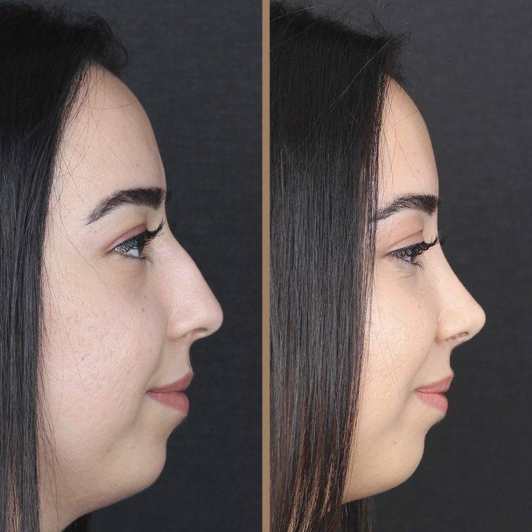 antalya-rhinoplasty-surgery-cost-dr-nazli-selvi-12
