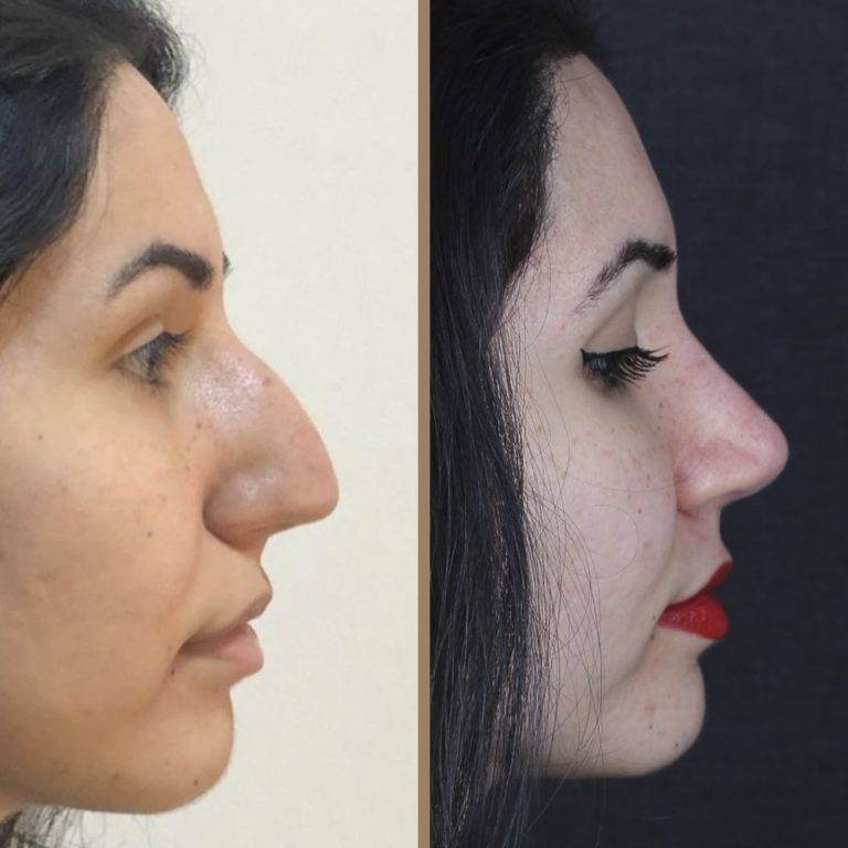 antalya-rhinoplasty-surgery-cost-dr-nazli-selvi-13