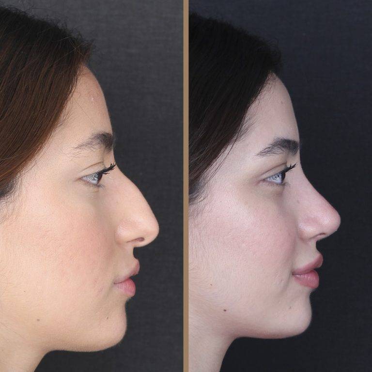 antalya-rhinoplasty-surgery-cost-dr-nazli-selvi-14