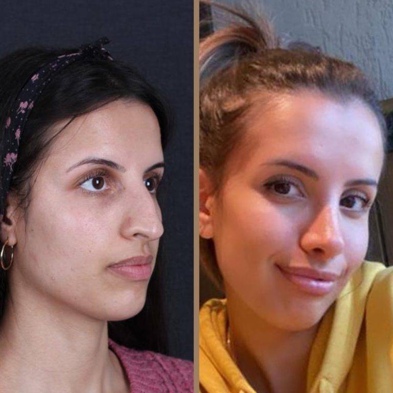 antalya-rhinoplasty-surgery-cost-dr-nazli-selvi-17