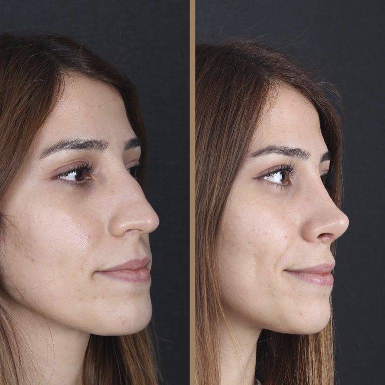 antalya-rhinoplasty-surgery-cost-dr-nazli-selvi-18