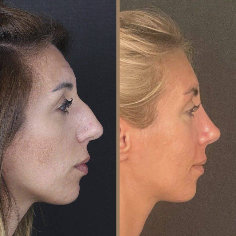 antalya-rhinoplasty-surgery-cost-dr-nazli-selvi-19