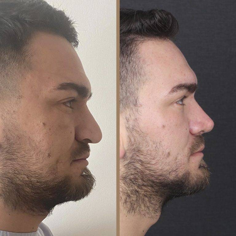 antalya-rhinoplasty-surgery-cost-dr-nazli-selvi