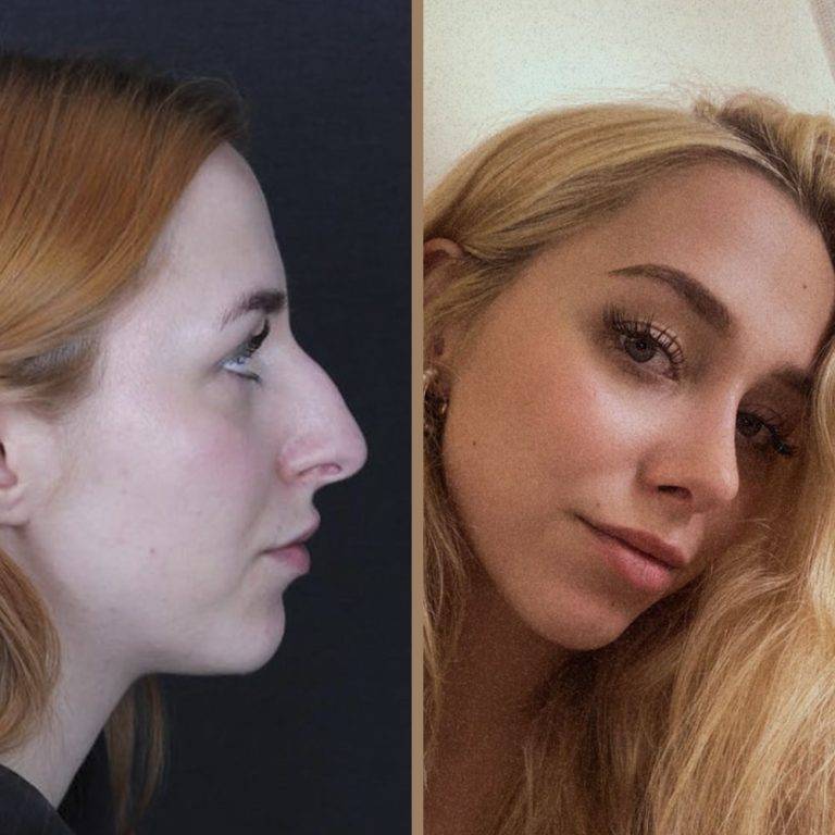 antalya-rhinoplasty-surgery-cost-dr-nazli-selvi-8