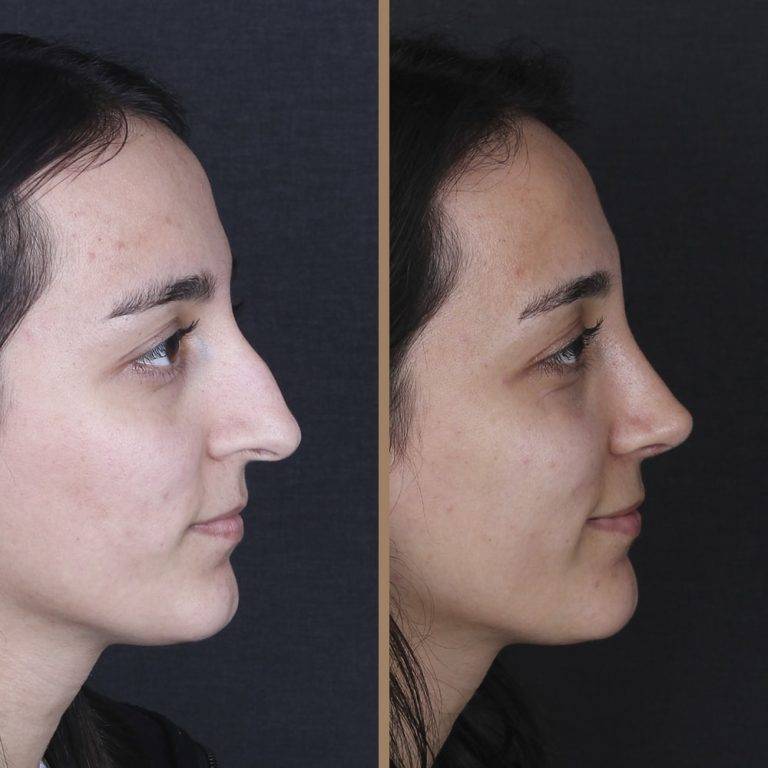 antalya-rhinoplasty-surgery-cost-dr-nazli-selvi-9