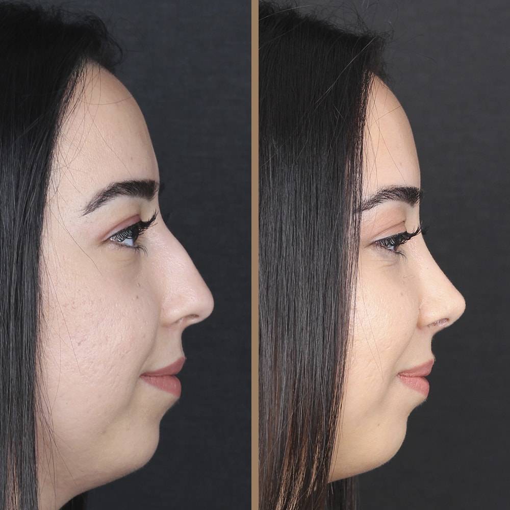 antalya-rhinoplasty-surgery-cost-dr-nazli-selvi-12.jpg