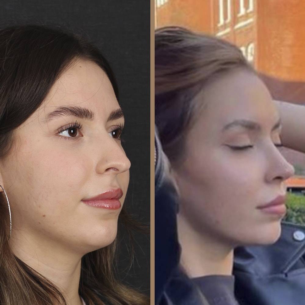 antalya-rhinoplasty-surgery-cost-dr-nazli-selvi-15.jpg