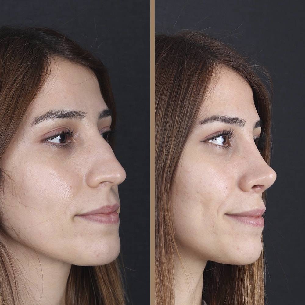 antalya-rhinoplasty-surgery-cost-dr-nazli-selvi-18.jpg