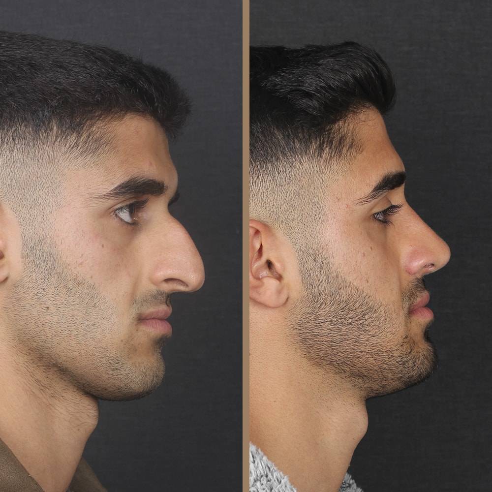 antalya-rhinoplasty-surgery-cost-dr-nazli-selvi-3.jpg