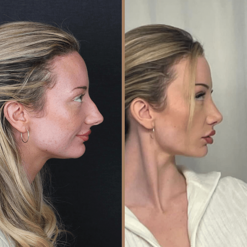Before After Rhinoplasty Patient 7