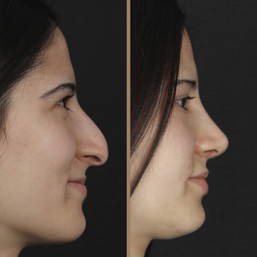 antalya-rhinoplasty-surgery-cost-dr-nazli-selvi-7.jpg