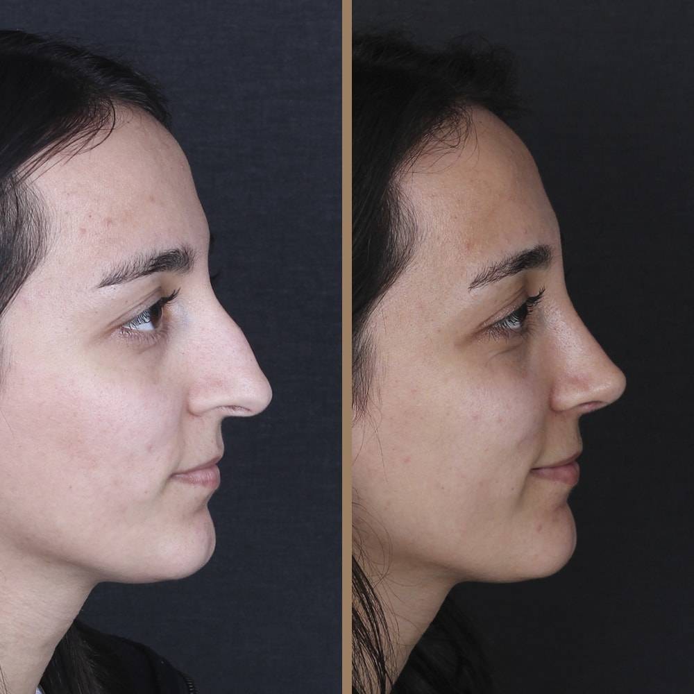 antalya-rhinoplasty-surgery-cost-dr-nazli-selvi-9.jpg