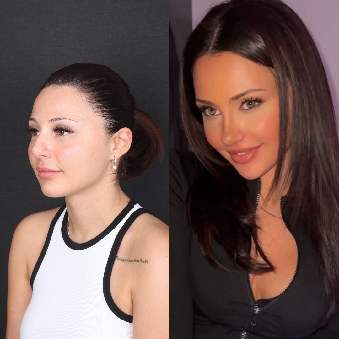 Before After Rhinoplasty Patient 5