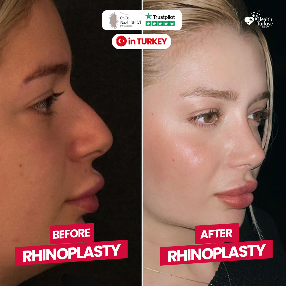 Before After Rhinoplasty Patient 1