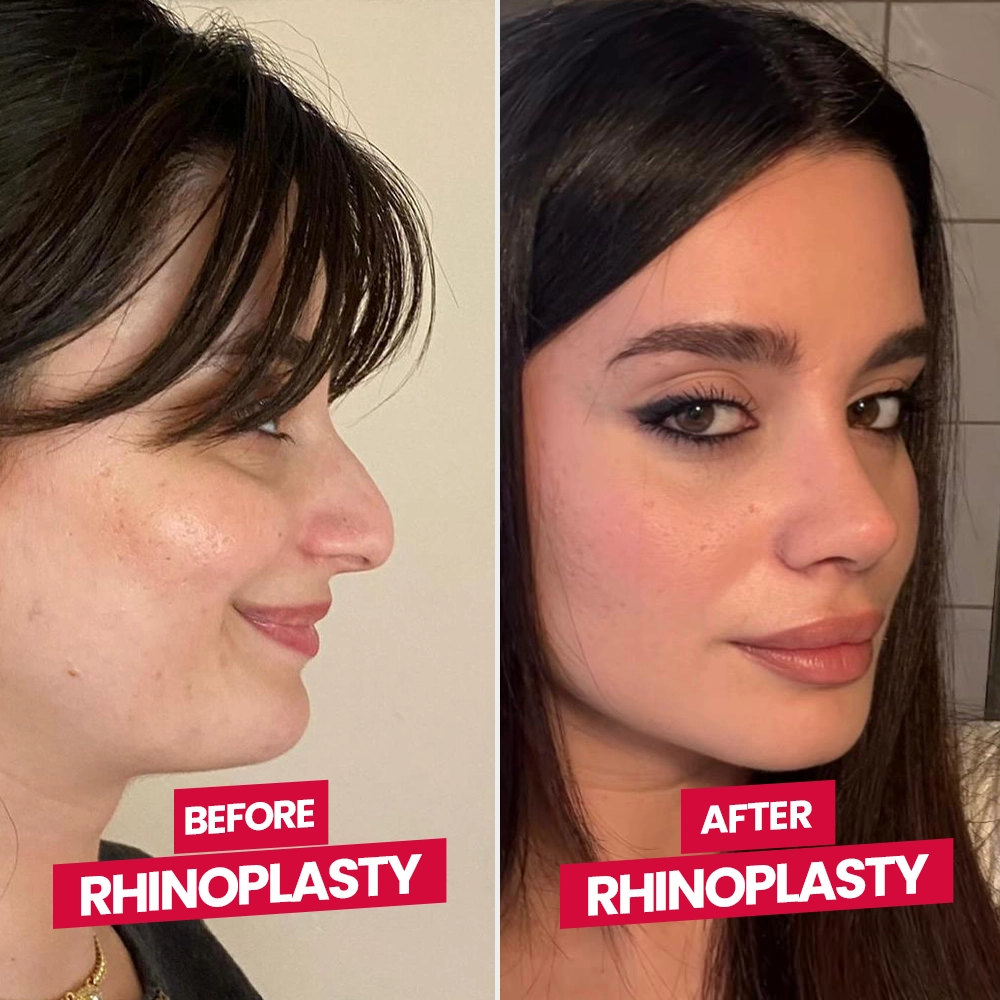 Before After Rhinoplasty Patient 4