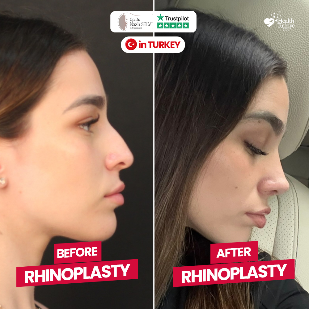 Before After Rhinoplasty Patient 3