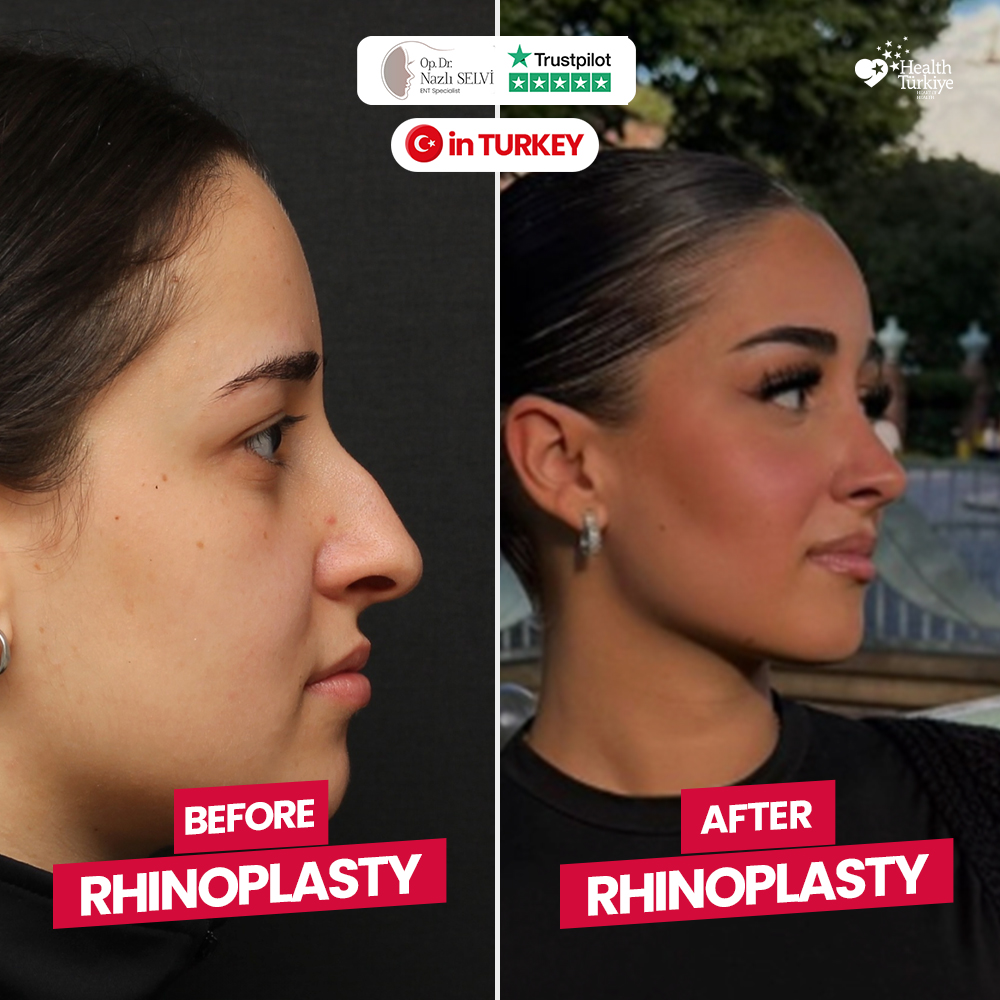 Before After Rhinoplasty Patient 3