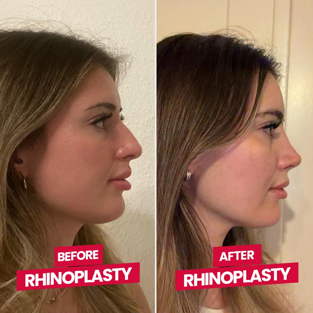 Before After Rhinoplasty Patient 2