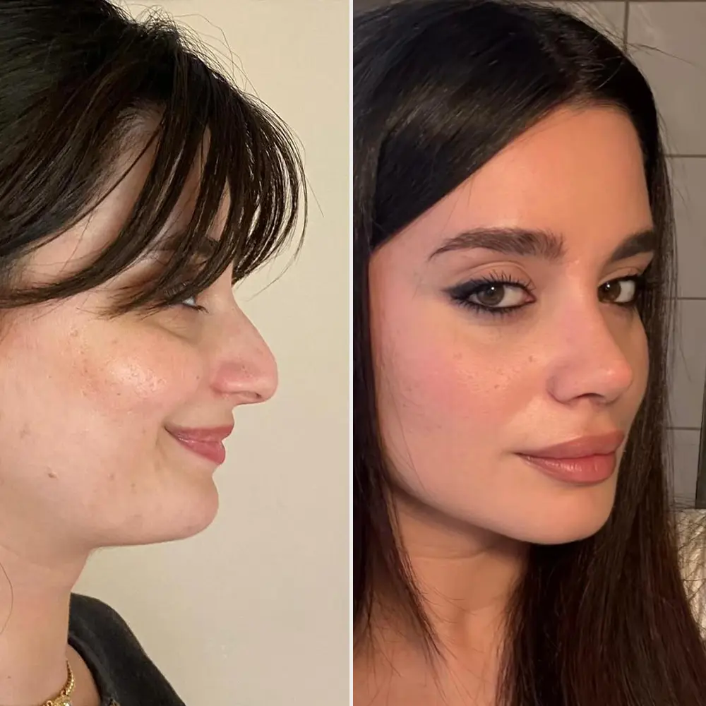 Kadın hastada burun estetiği öncesi ve sonrası — Op. Dr. Nazlı Selvi