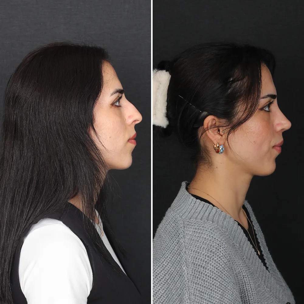 Kadın hastada burun estetiği öncesi ve sonrası — Op. Dr. Nazlı Selvi