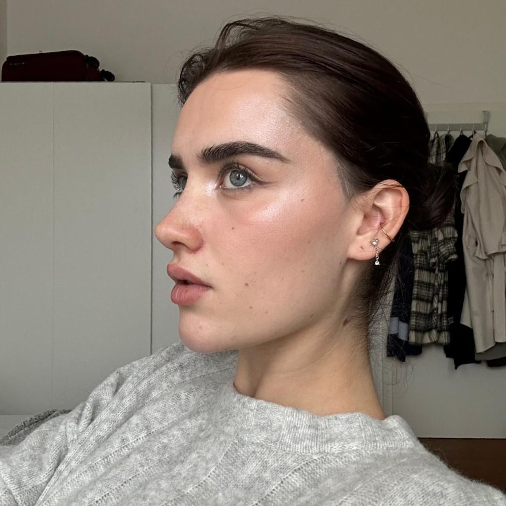 rhinoplasty-after-before